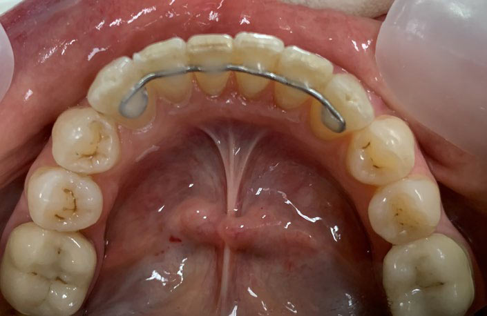 Abb. 11: Ausgeformter Unterkiefer nach Abschluss der ClearCorrect-Behandlung nach rund acht Monaten. Zur Retention wurde im Dentallabor für den Unterkiefer ein fester Retainer erstellt. Foto: ZÄ Swantje Matthes
